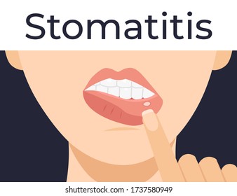 Stomatitis. Woman has inflammation of the mouth and lips. Flat vector cartoon modern illustration.