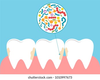 Stomatological concept. Plaque on the teeth, bacteria and germs damage tooth enamel. Vector illustration.