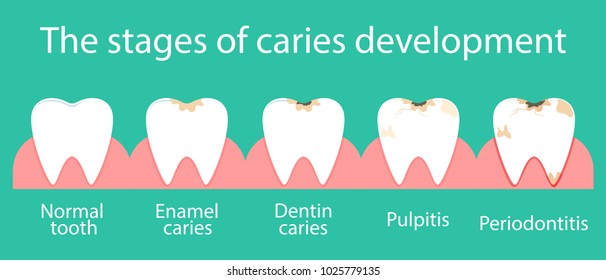 
Stomatological concept. Stages of caries development. Development of dental caries, pathogenic microflora in the oral cavity. Vector illustration.