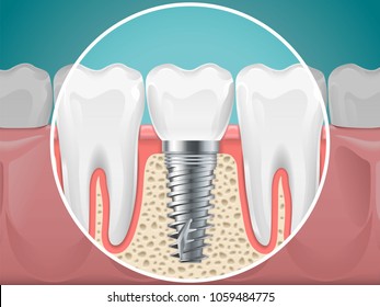 Stomatology illustrations. Dental implants and healthy teeth. Vector health tooth and implant stomatology, dentistry installation and fixture