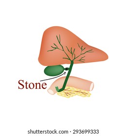 Stone bile duct. Gallbladder, duodenum, pancreas, bile ducts. Vector illustration on isolated background.