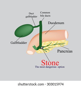 Stone pancreatic bile duct. The gall bladder, duodenum, bile ducts. Vector illustration on a gray background.