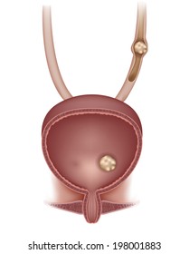 Stones in the urinary bladder and ureter. 