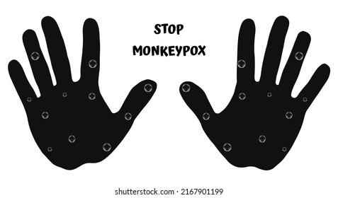 Stop Monkeypox Black And White Vector Illustration, Human Hands With Smallpox Rash.