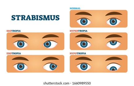 Exotropia Images Stock Photos Vectors Shutterstock