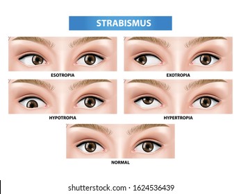 Esotropia Images Stock Photos Vectors Shutterstock