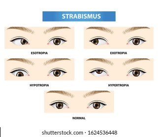 Strabismus, crossed eye vector illustration