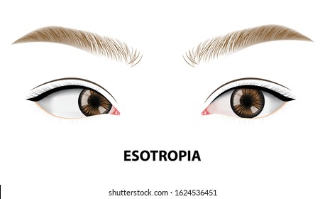 Strabismus, crossed eye vector illustration