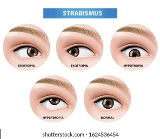 Strabismus, crossed eye vector illustration