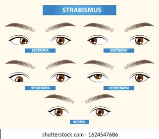 Strabismus, crossed eye vector illustration