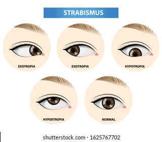 Strabismus , crossed eye vector illustration