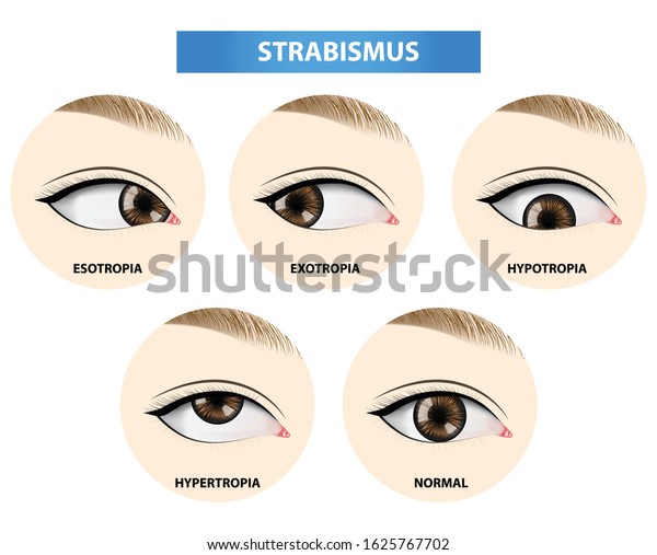 Strabismus Crossed Eye Vector Illustration Stock Vector (Royalty Free ...