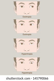 Strabismus Defect Esotropia, Exotropia, Hypertropia, Hypotropia