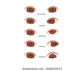 Strabismus eye disease concept. Eye misalignment, emphasizing conditions like esotropia and exotropia. Hypertropia and hypotropia. Binocular vision issues, diagnosis and treatment vector illustration