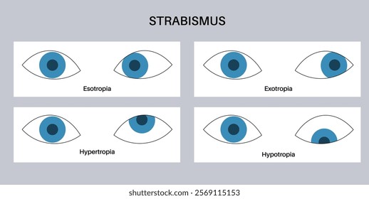 Strabismus eye disease concept. Eye misalignment, emphasizing conditions like esotropia and exotropia. Hypertropia and hypotropia. Binocular vision issues, diagnosis and treatment vector illustration