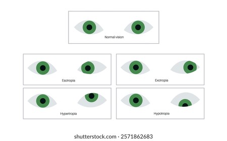 Strabismus eye disease concept. Eye misalignment, emphasizing conditions like esotropia and exotropia. Hypertropia and hypotropia. Binocular vision issues, diagnosis and treatment vector illustration