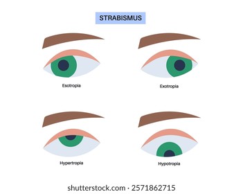 Strabismus eye disease concept. Eye misalignment, emphasizing conditions like esotropia and exotropia. Hypertropia and hypotropia. Binocular vision issues, diagnosis and treatment vector illustration