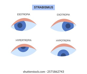 Strabismus eye disease concept. Eye misalignment, emphasizing conditions like esotropia and exotropia. Hypertropia and hypotropia. Binocular vision issues, diagnosis and treatment vector illustration