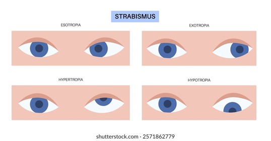 Strabismus eye disease concept. Eye misalignment, emphasizing conditions like esotropia and exotropia. Hypertropia and hypotropia. Binocular vision issues, diagnosis and treatment vector illustration