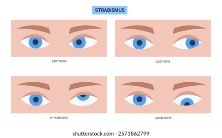 Strabismus eye disease concept. Eye misalignment, emphasizing conditions like esotropia and exotropia. Hypertropia and hypotropia. Binocular vision issues, diagnosis and treatment vector illustration