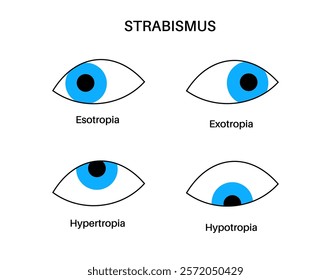 Strabismus eye disease concept. Eye misalignment, emphasizing conditions like esotropia and exotropia. Hypertropia and hypotropia. Binocular vision issues, diagnosis and treatment vector illustration