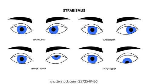 Strabismus eye disease concept. Eye misalignment, emphasizing conditions like esotropia and exotropia. Hypertropia and hypotropia. Binocular vision issues, diagnosis and treatment vector illustration