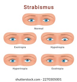 Strabismus eyes types normal hypotropia hypertropia exotropia esotropia scheme vector flat illustration. Ophthalmology crossed condition eyeball movement disorder diagnosis optical vision dysfunction