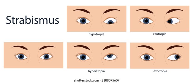 Strabismus flat style infographic set of stages: normal and disorders, European person.