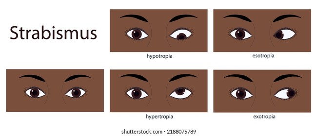 Strabismus flat style infographic set of stages: normal and disorders.