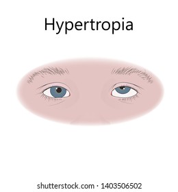 Strabismus in infants, child, kid. Hypertropia, upward eyes. Vector flat medical illustration.