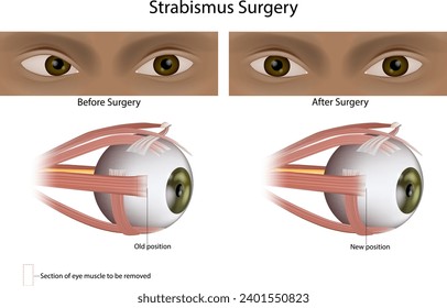 La cirugía de Strabismus o Squint trata los ojos desalineados. Cirugía Muscular Ocular. Oftalmología