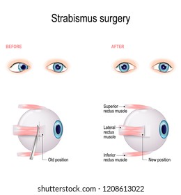 Strabismus Surgery. Eye muscle recession. Extraocular Muscle Anatomy. surgeon alters the attachment site of the muscle, cutting the muscle from the surface of the eye and reattaching it further back