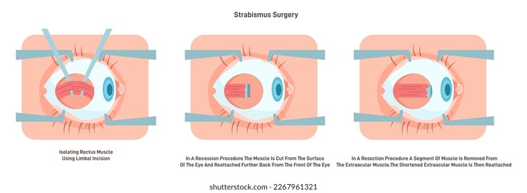 73 Strabismus Surgery Stock Vectors, Images & Vector Art | Shutterstock
