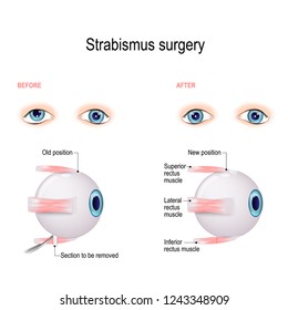 Strabismus Surgery. Hypertropia. Eye muscle recession. Extraocular Muscle Anatomy. 