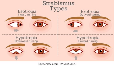 Strabismus types, crossed eyes, disease. Inward turning, outward, upward, downward. Esotropia, hypotropia, exotropia, hypertropia,. Skin color background. Vector illustration	