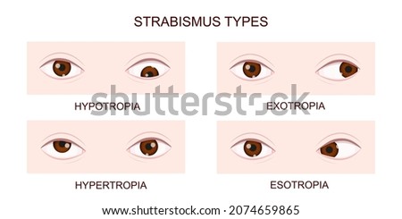 Strabismus types. Hypotropia, hypertropia, exotropia, esotropia. Human eyes with different squint disorders. Crossed eyes condition. Vector realistic illustration.