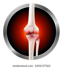 Straight leg bone pain shows symptoms of knee joint inflammation, swelling, redness. vector illustration file.