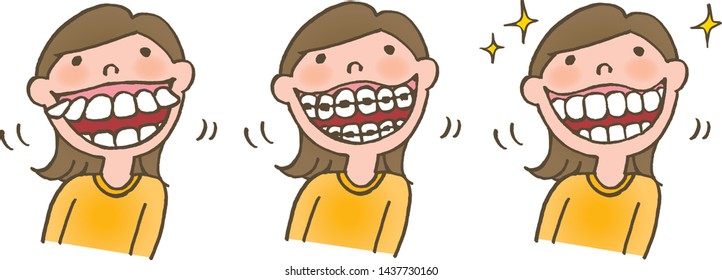 Straightening of irregular teeth