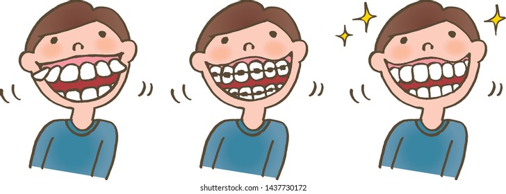 Straightening of irregular teeth