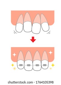 Straightening rattling teeth Front teeth orthodontic