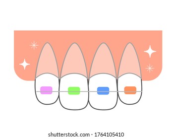 Straightening rattling teeth Front teeth orthodontic