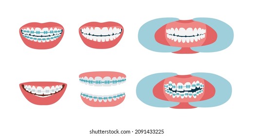 Straightening Teeth With Braces. Orthodontic Treatment Stages. Mouth With Crooked Teeth, Bracketed And Straight. A Healthy Smile. Isolated Flat Vector Illustration.