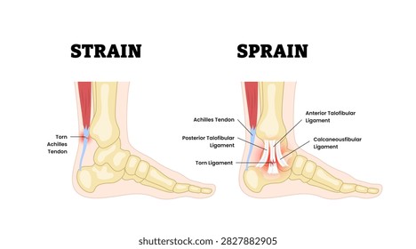Strain vs Sprain anatomical comparison as medical foot injury. Feet bone disorder condition. orthopedic muscle, tendon and ligament problem. Medical education poster flat vector illustration.
