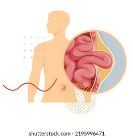 Strangulated Hernia -  Section of the Small Intestines - Stock Illustration as EPS 10 File