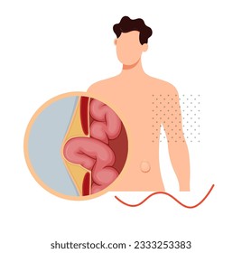 Strangulated Hernia -  Section of the Small Intestines - Stock Illustration as EPS 10 File