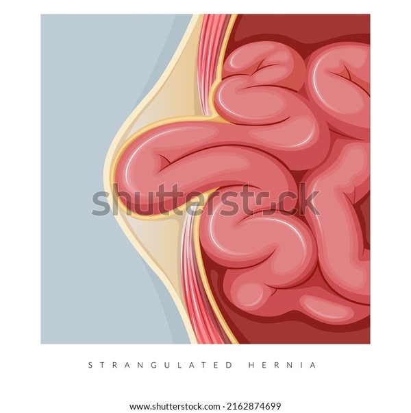 Strangulated Hernia -  Section of the Small\
Intestines - Stock Illustration as EPS 10\
File