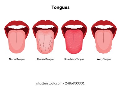 Strawberry tongue, normal tongue, cracked and wavy tongues