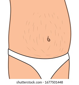 Streaks or stripes on the skin, especially on the abdomen, caused by distension of the skin from obesity or during pregnancy.