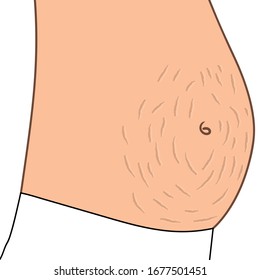 Streaks or stripes on the skin, especially on the abdomen, caused by distension of the skin from obesity or during pregnancy.