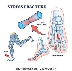 Explicación de la fractura de estrés con el diagrama esquelético de la lesión ósea del pie. Esquema educativo etiquetado con falanges desgarre después de actividades de funcionamiento físico y uso excesivo en ilustración de vectores caminantes